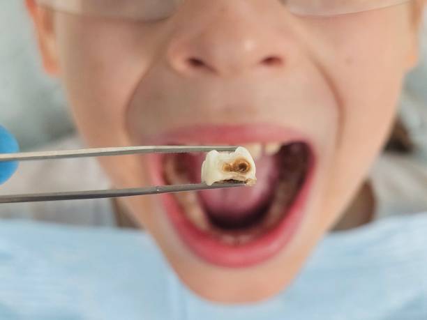 Best Chipped Tooth Repair Near Me  in Fallbrook, CA